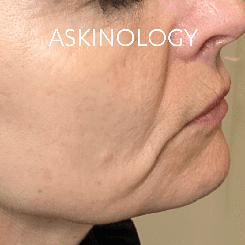 Secret RF treatment at askinology - before photo