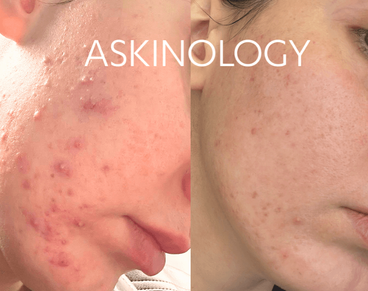 acne laser treatment before and after